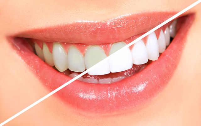 Tẩy trắng răng có hại không ?