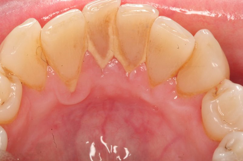 Cao răng là mảng bám cứng gây hại, cần lấy định kỳ để bảo vệ răng