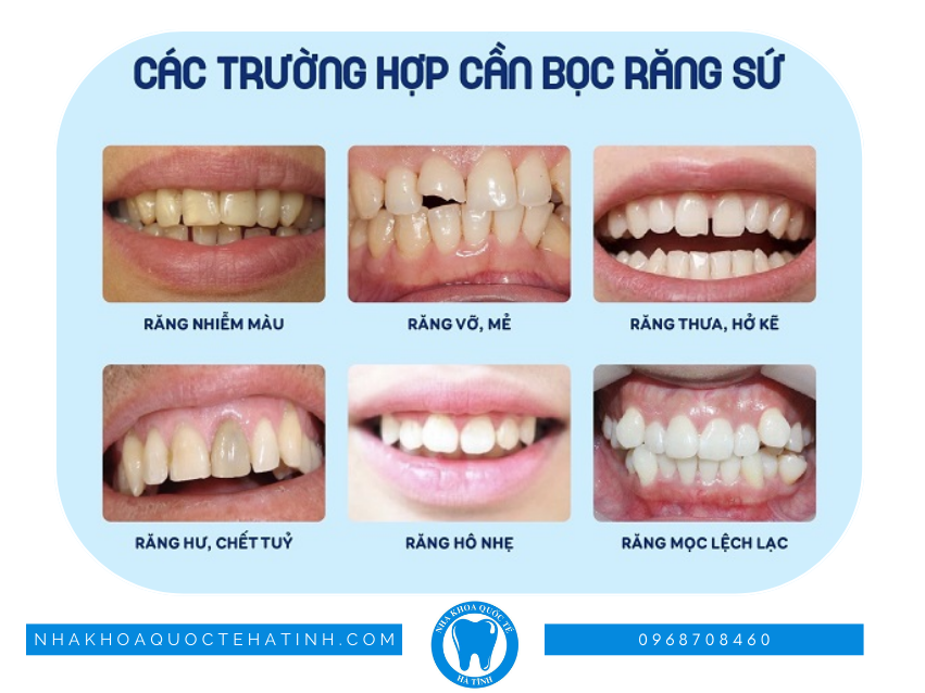 Bọc răng sứ tại Hà Tĩnh 