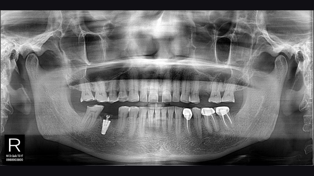 Nha khoa cấy ghép implant tại Hà Tĩnh