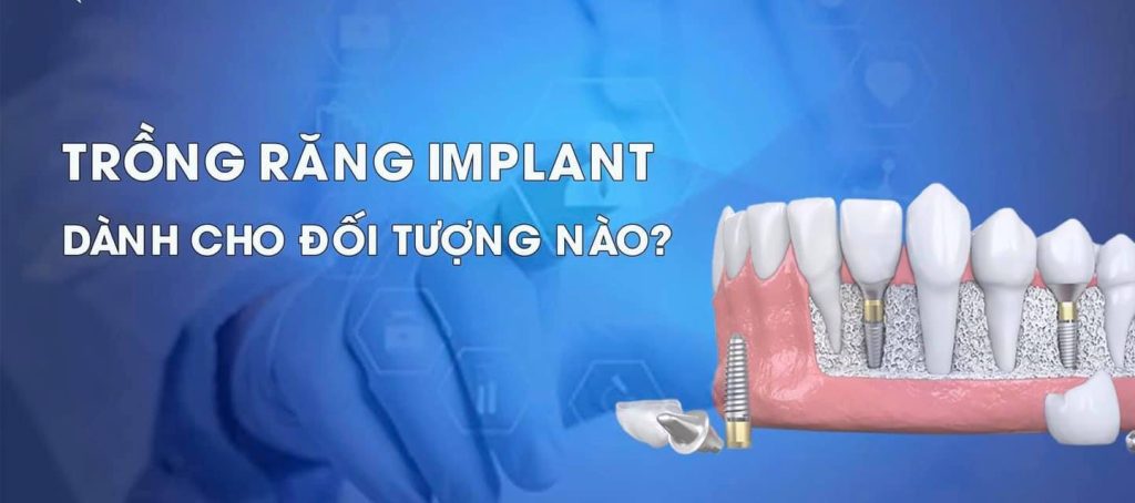 Nha khoa cấy ghép implant tại Hà Tĩnh