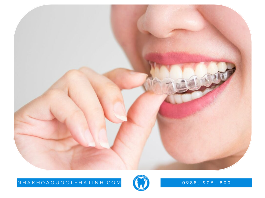 Niềng răng trong suốt là giải pháp chỉnh nha hiện đại, thẩm mỹ cao, tiện lợi và ngày càng được ưa chuộng tại Hà Tĩnh.