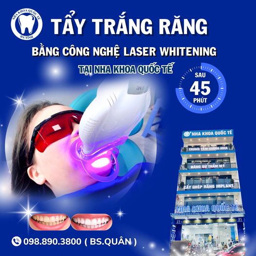 Tẩy trắng răng Laser Whitening là gì?