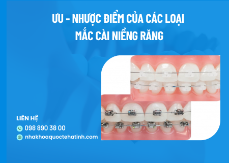 Ưu – nhược điểm của các loại mắc cài niềng răng