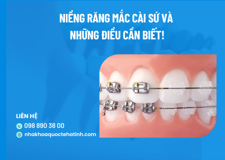 Niềng răng mắc cài sứ và những điều cần biết!