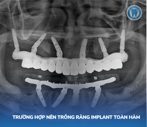 Trường hợp nên trồng răng toàn hàm