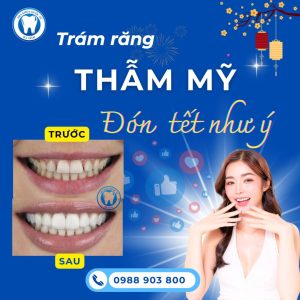 Lợi ích vượt trội của trám răng thẩm mỹ tại Nha Khoa Quốc Tế