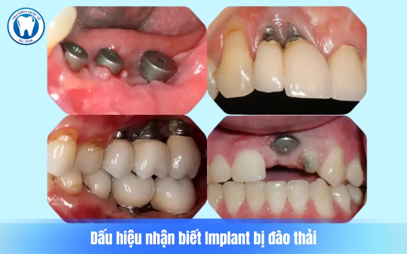 Nhận biết sớm dấu hiệu bất thường giúp Implant bền lâu và tránh biến chứng nguy hiểm.