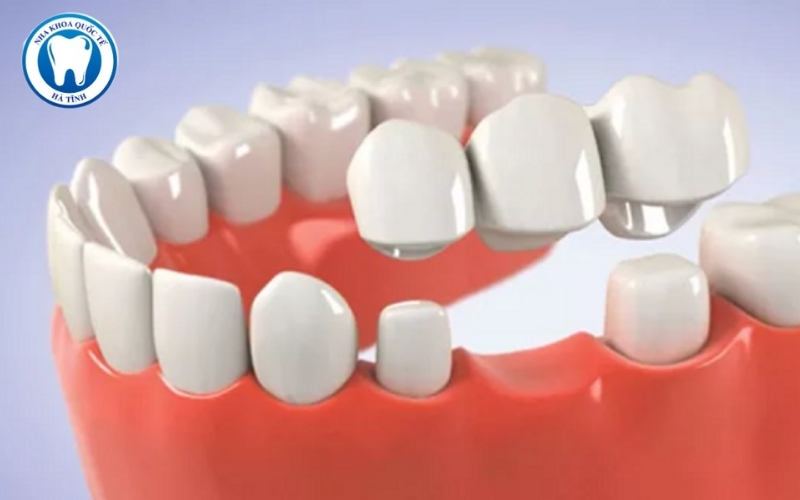 Cầu răng phục hình răng mất nhờ mão sứ gắn trên răng kế cận.