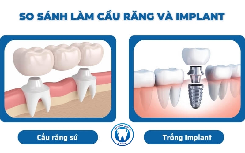 Implant và Cầu răng sứ là hai phương pháp phổ biến giúp phục hồi răng mất hiệu quả hiện nay.