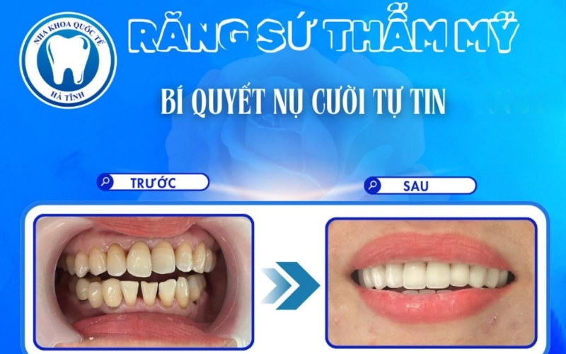 Bọc răng sứ Hà Tĩnh giúp phục hồi thẩm mỹ, bảo vệ răng thật và cải thiện chức năng ăn nhai hiệu quả
