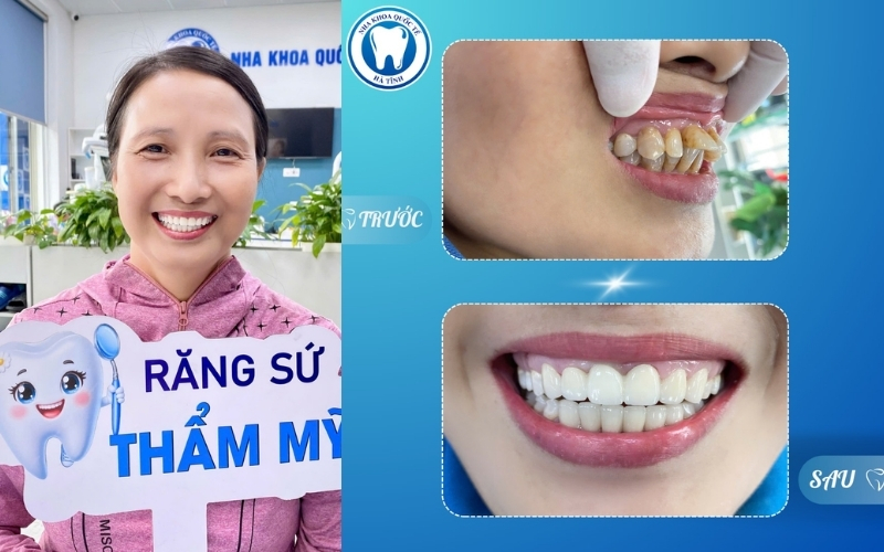 Bọc răng sứ thẩm mỹ