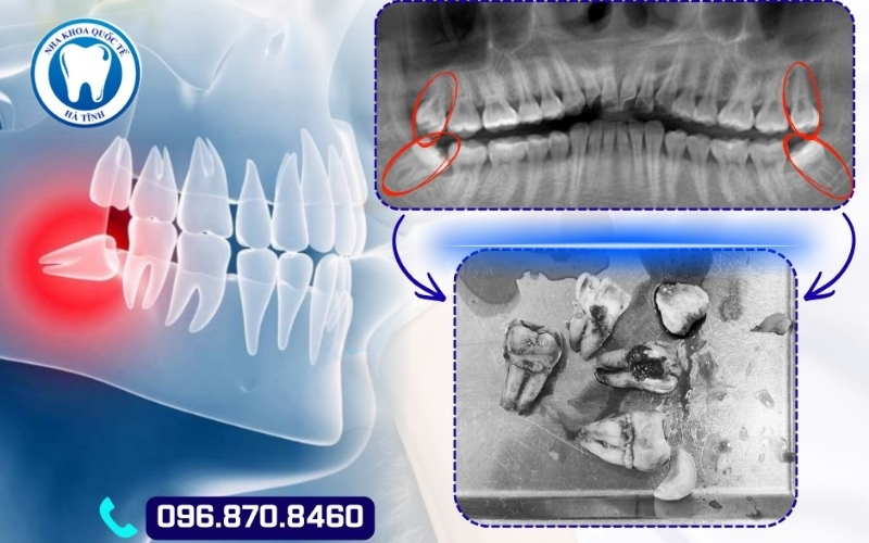 Răng khôn mọc lệch dễ gây biến chứng nên cần thăm khám và nhổ sớm