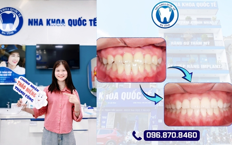 Chỉnh nha đúng thời điểm giúp tăng hiệu quả, giảm thời gian và chi phí.