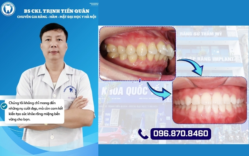 Nha Khoa Quốc Tế Hà Tĩnh mang đến dịch vụ niềng răng chuyên nghiệp, hiện đại, chi phí hợp lý