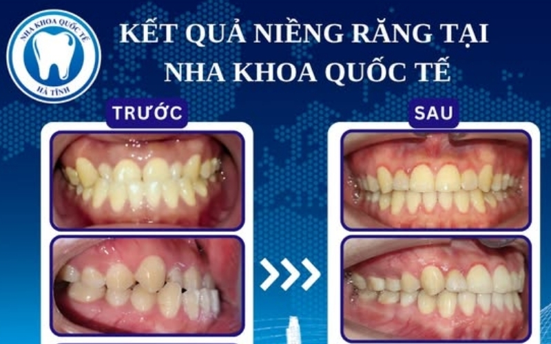 Chi phí niềng răng tại Hà Tĩnh phụ thuộc vào nhiều yếu tố chuyên môn và điều trị