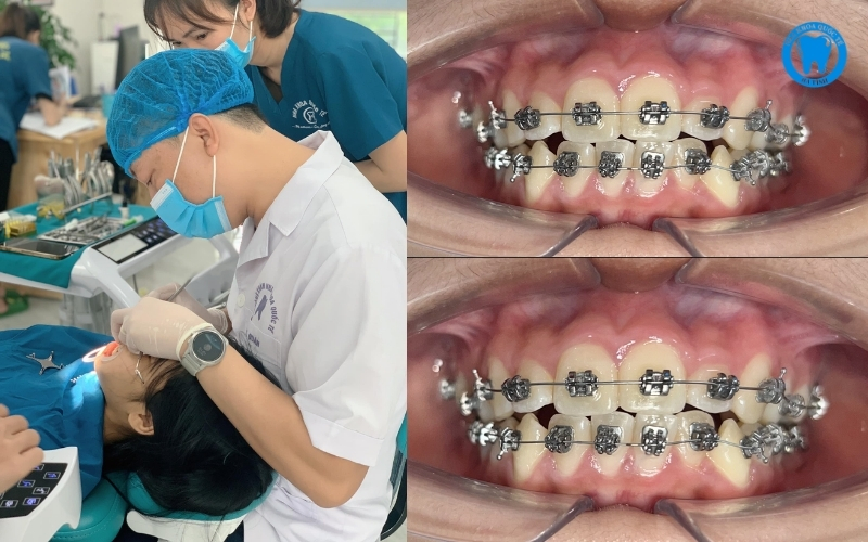 Niềng răng thẩm mỹ