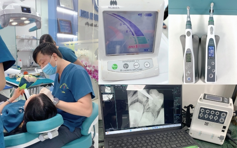 Quy trình điều trị tủy bằng máy hiện đại tại Nha Khoa Quốc Tế Hà Tĩnh giúp giảm đau và tăng hiệu quả điều trị