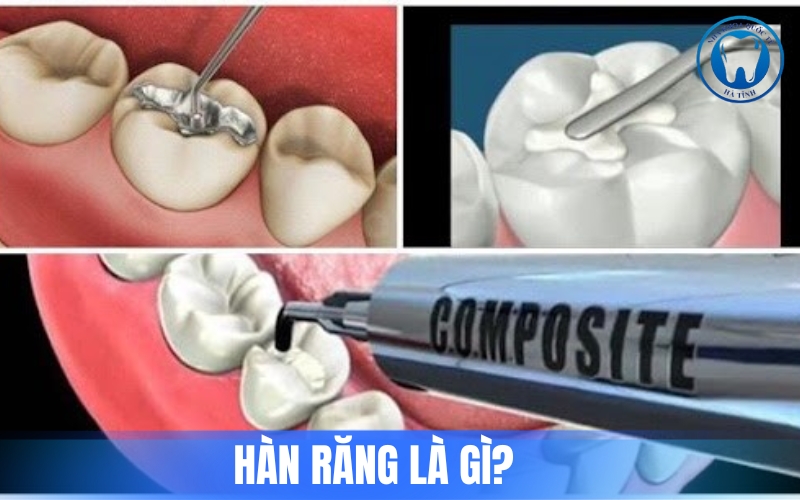 Hàn răng là kỹ thuật phục hồi răng sâu mẻ giúp bảo vệ răng miệng