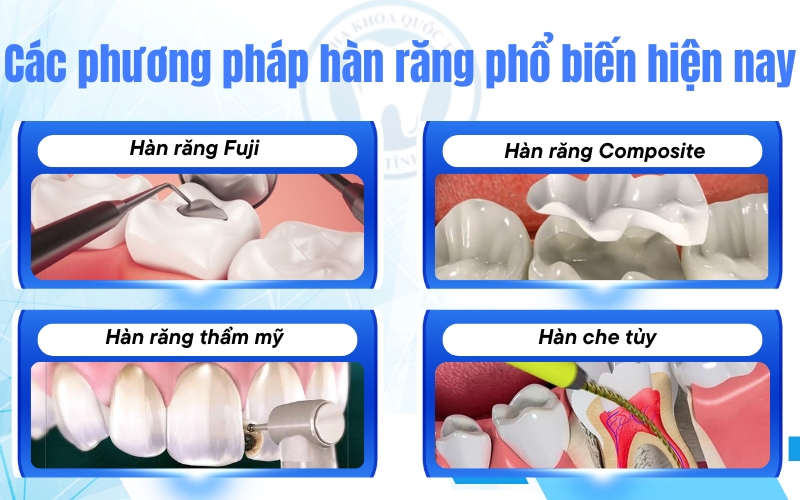 Các phương pháp hàn răng hiện đại giúp phục hồi thẩm mỹ và bảo vệ răng hiệu quả lâu dài.