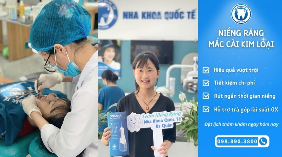 Niềng răng mắc cài kim loại tại Hà Tĩnh hiệu quả cao, chi phí hợp lý, được nhiều người lựa chọn