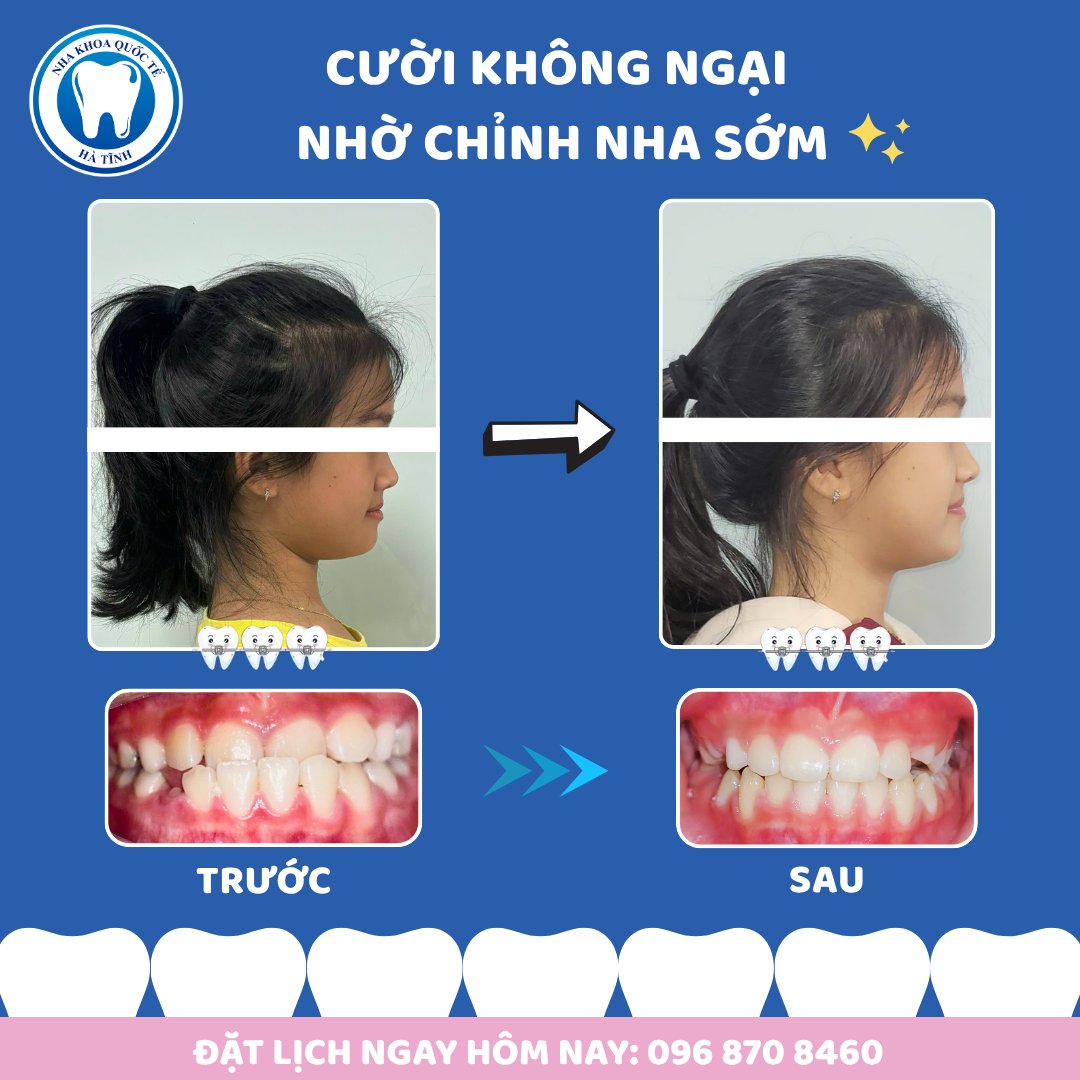 Niềng răng sớm giúp trẻ cải thiện khớp cắn, thẩm mỹ và phát triển răng hàm toàn diện