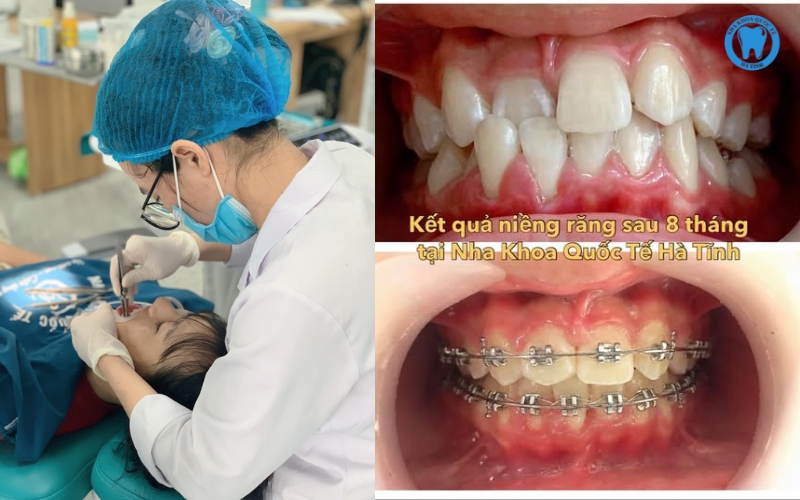 Rút ngắn niềng răng cần tuân thủ bác sĩ, chăm sóc tốt và tái khám đúng lịch