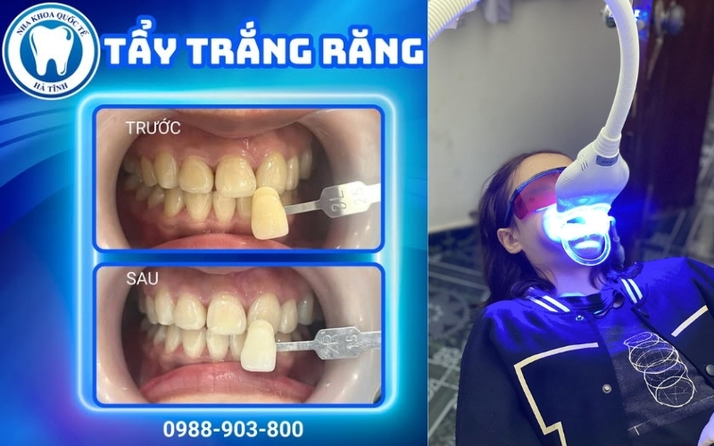 Tẩy trắng răng giúp cải thiện màu sắc răng ố vàng, mang lại nụ cười trắng sáng tự nhiên