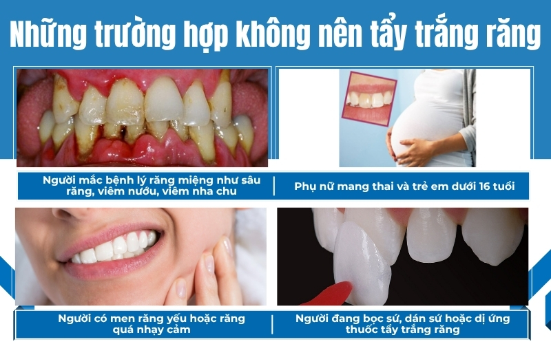 Một số trường hợp đặc biệt cần thăm khám kỹ trước khi tẩy trắng răng