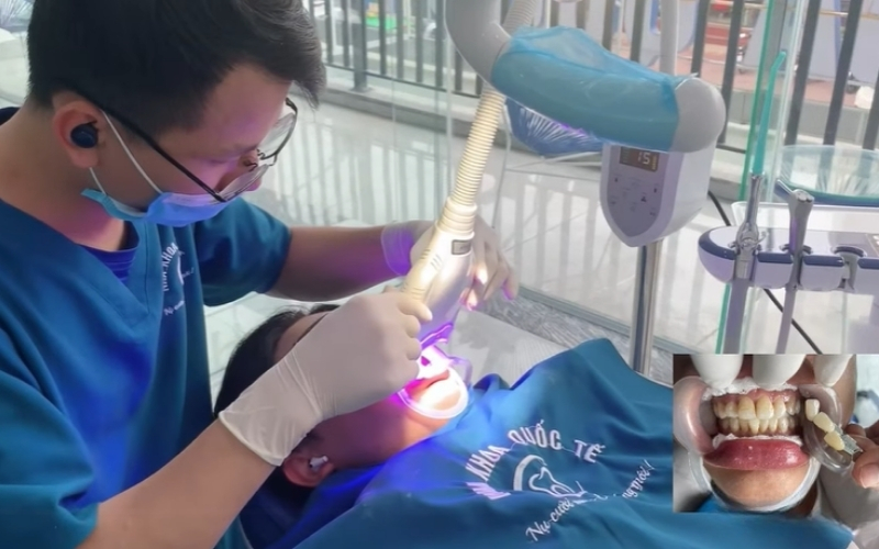 Tẩy trắng răng đúng kỹ thuật không làm yếu răng, đồng thời cải thiện thẩm mỹ nụ cười hiệu quả