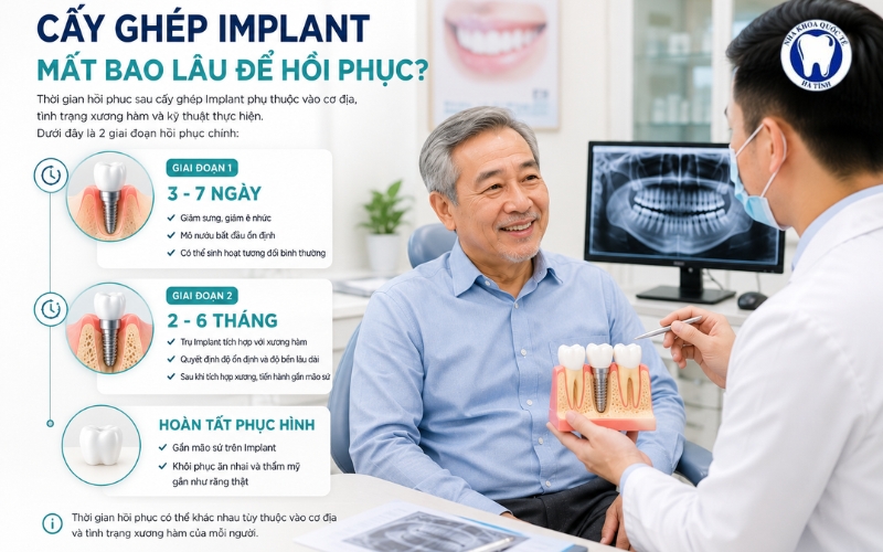 Cấy ghép Implant cần vài ngày lành thương và vài tháng tích hợp xương