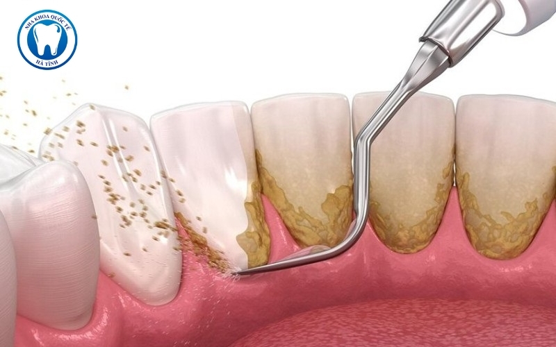 Lấy cao răng tại Hà Tĩnh an toàn, không đau nếu thực hiện đúng kỹ thuật nha khoa hiện đại