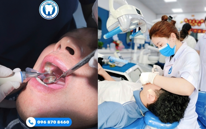 Lấy cao răng tại Hà Tĩnh nên thực hiện 3–6 tháng một lần để bảo vệ răng miệng khỏe mạnh lâu dài