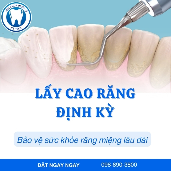 Lấy cao răng định kỳ giúp phòng ngừa viêm nướu, giữ răng chắc khỏe lâu dài hiệu quả