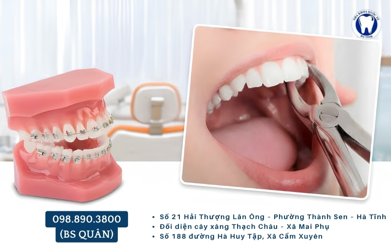 Niềng răng có phải nhổ răng không phụ thuộc tình trạng răng và cung hàm