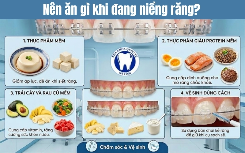 Thực phẩm nên ăn khi niềng răng gồm đồ mềm, giàu dinh dưỡng, hỗ trợ răng chắc khỏe hiệu quả