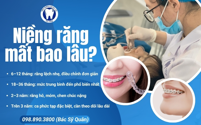 Niềng răng mất bao lâu phụ thuộc tình trạng răng, thường kéo dài từ 6 đến 36 tháng