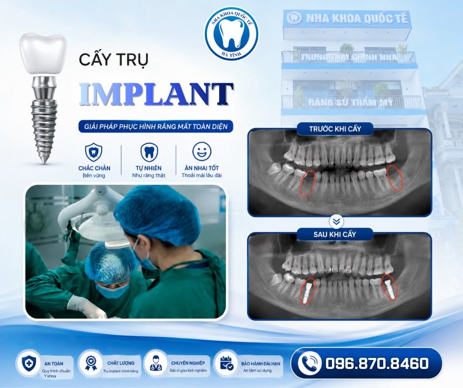 Trồng răng Implant giúp phục hồi răng mất, ăn nhai chắc khỏe và thẩm mỹ tự nhiên