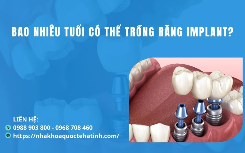 Bao nhiêu tuổi có thể trồng răng implant?