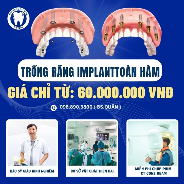 Chi phí trồng răng toàn hàm phụ thuộc số trụ Implant và tình trạng xương