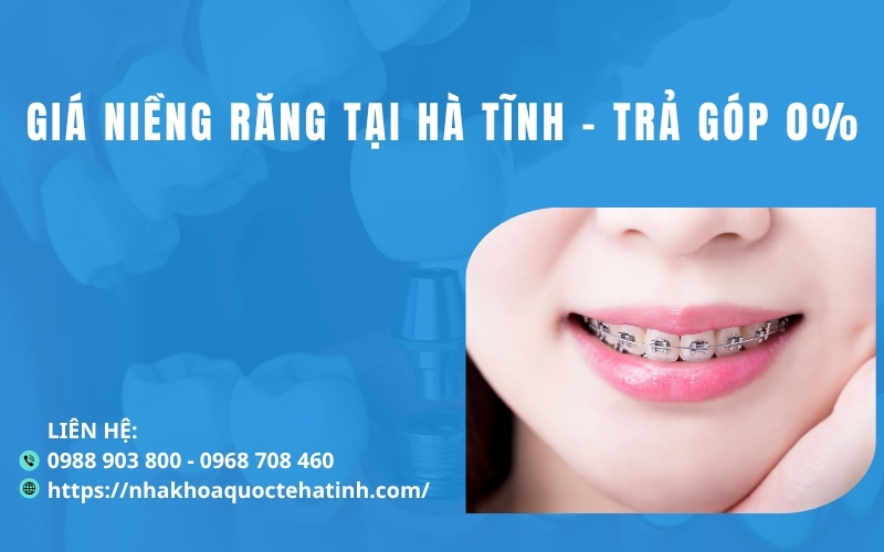 Giá niềng răng tại Hà Tĩnh – Trả góp 0%
