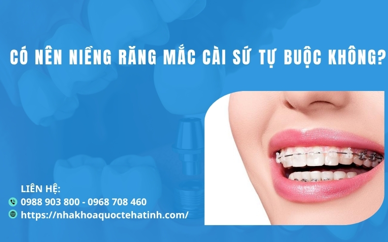 Có nên niềng răng mắc cài sứ tự buộc không?
