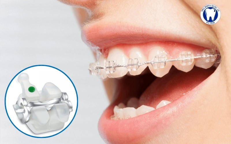 Mắc cài sứ tự buộc sử dụng chốt khóa thông minh, giúp chỉnh nha hiệu quả và tăng tính thẩm mỹ