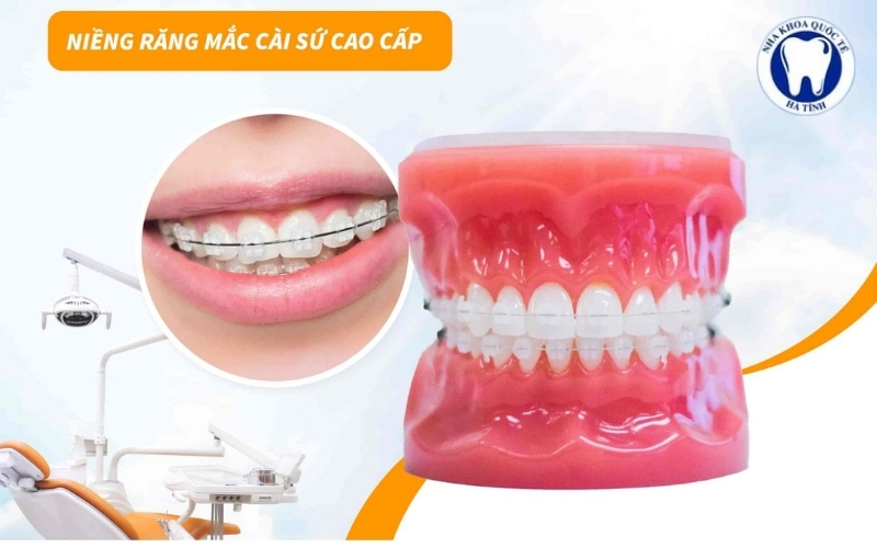 Niềng răng mắc cài sứ sử dụng mắc cài sứ thẩm mỹ, giúp dịch chuyển răng đều và chuẩn khớp cắn