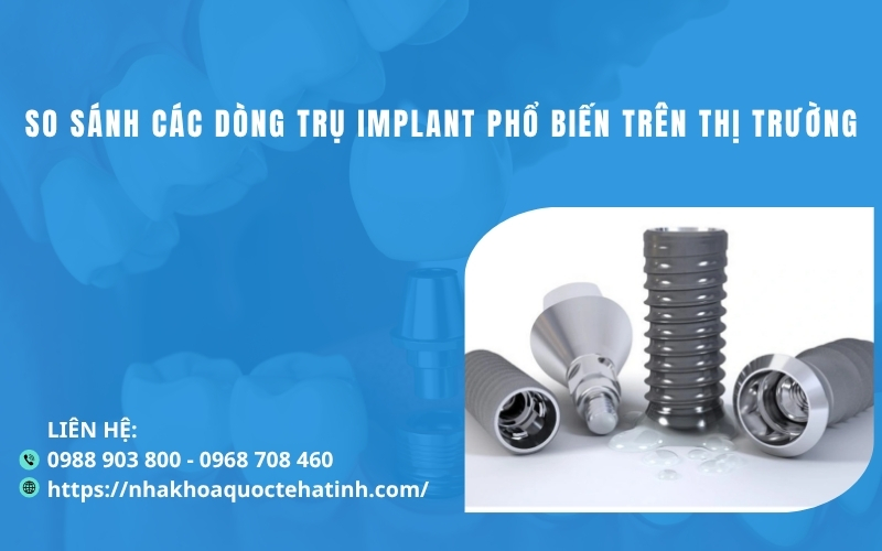 So sánh các dòng trụ Implant phổ biến trên thị trường