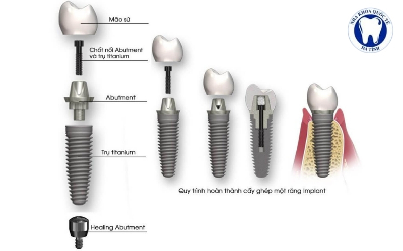 Trụ Implant quyết định khả năng ăn nhai, độ bền và hiệu quả phục hồi răng mất lâu dài
