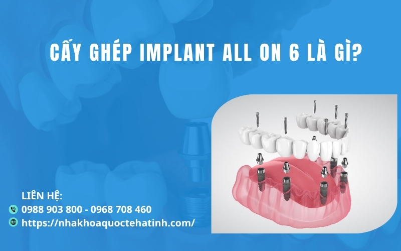 Cấy ghép Implant All On 6 là gì?