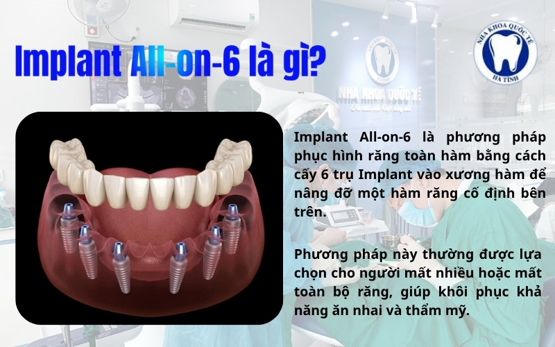 Implant All On 6 là giải pháp phục hình toàn hàm hiện đại, giúp khôi phục ăn nhai và thẩm mỹ hiệu quả
