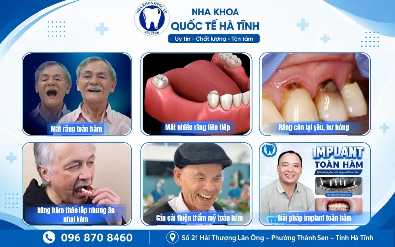 Implant All On 6 phù hợp với người mất nhiều răng, mất toàn hàm và cần phục hình cố định