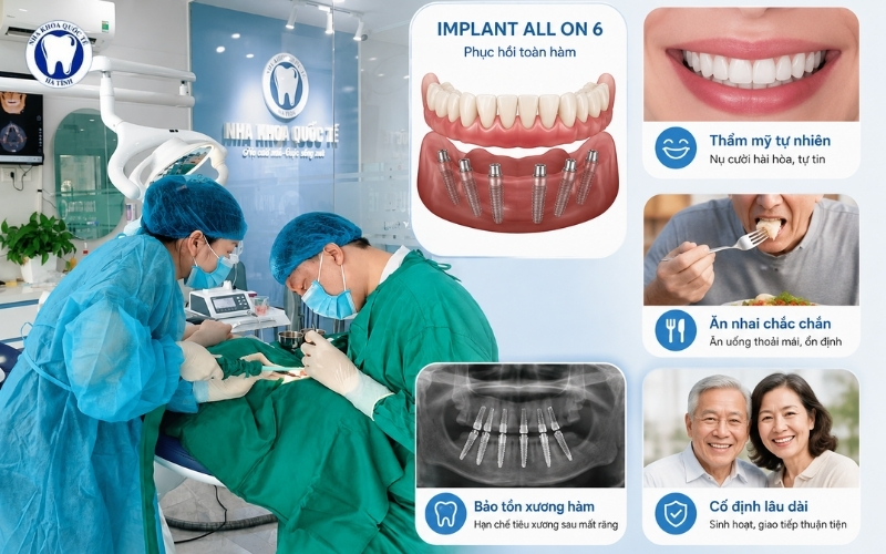 Implant All On 6 giúp phục hồi ăn nhai, thẩm mỹ và sự ổn định cho người mất răng toàn hàm